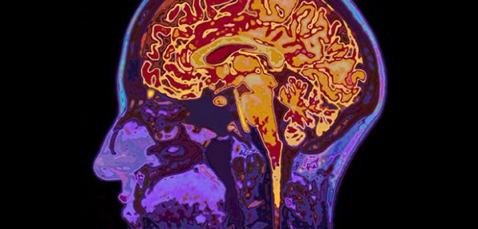 آیا ممکن است از شخص دیگری آلزایمر بگیرید ؟