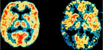 تشخیص آلزایمر۷ سال قبل از بروز اولین علائم