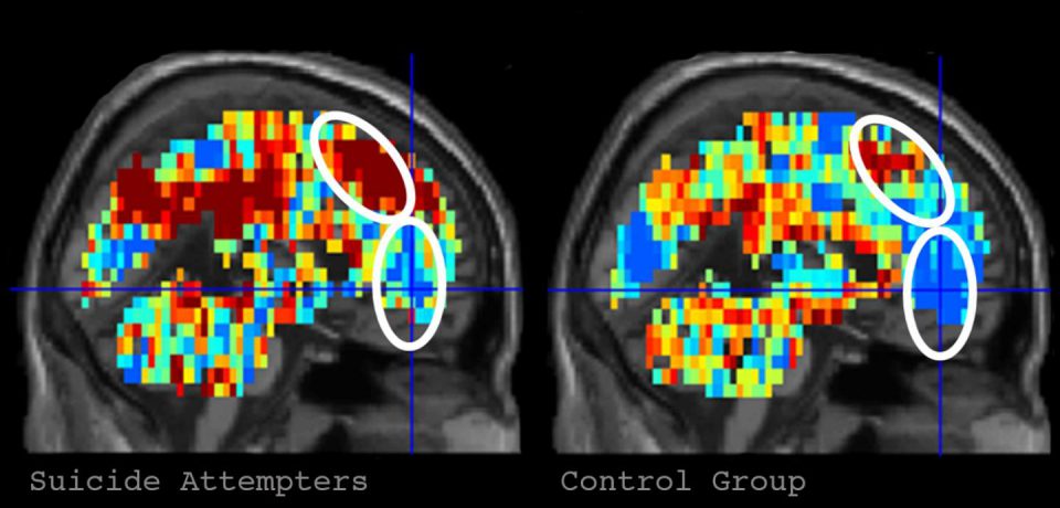 افکار مرتبط با خودکشی با اسکن مغزی ردیابی شدند