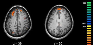شناسایی نقش ژن اختلال اسکیزوفرنی در رشد مغز