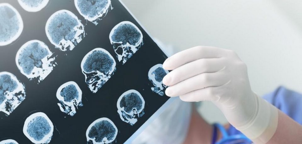 آلزایمر با ویروس تبخال مرتبط است