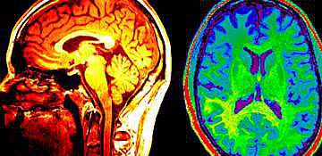 مغز می‌تواند در بزرگسالی نیز سلول‌های مغزی جدید تولید کند