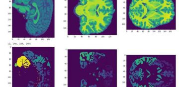 پیش‌بینی سطح هوش کودکان با MRI