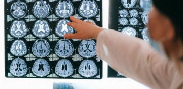 یافته جدید: کووید-۱۹ تاثیر مشابه آلزایمر بر مغز دارد!